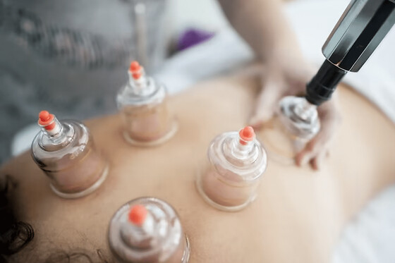 Séance de Cupping Therapy à Lyon